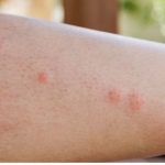 5 plantas medicinais para aliviar as picadas de insetos